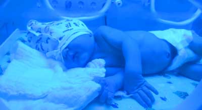 انواع روش های درمانی  زردی نوزاد استفاده از لامپ فلورسنت برای درمان زردی نوزاد