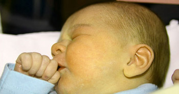 زردی نوزاد و مواردی که باعث بروز زردی نوزادان می ‌شوند