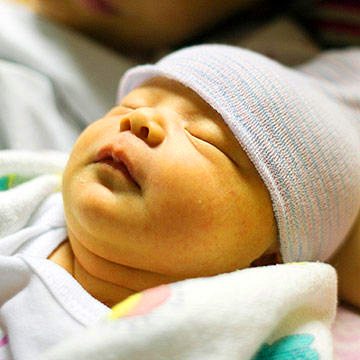 شایع ترین دلایل زردی نوزاد و زردی نوزاد از کدام قسمت بدنش شروع می شود