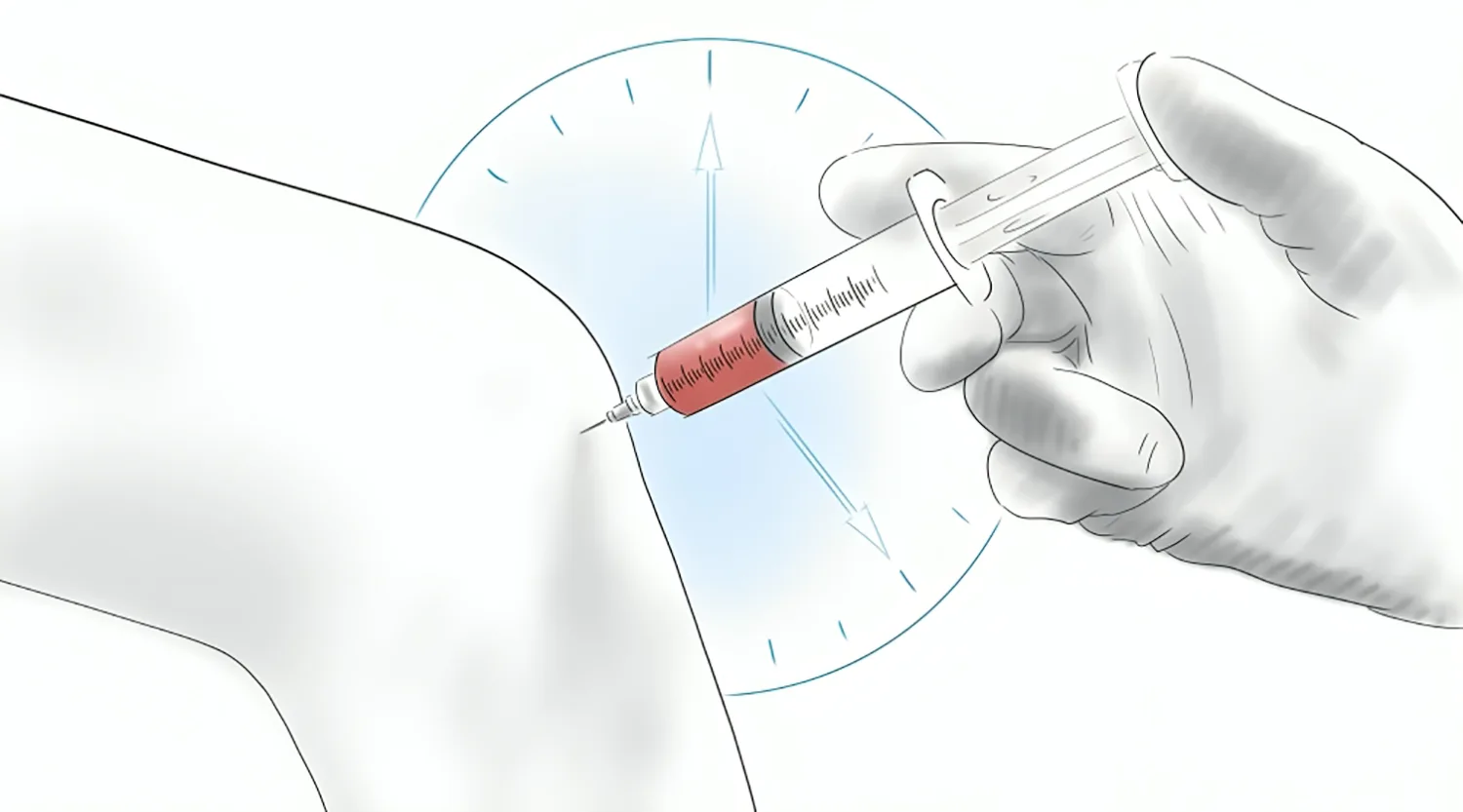 تزریق پلاسما در زانو